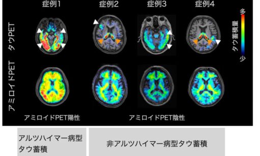 うつ病に認知症原因物質が関与か　早期診断へ期待へ